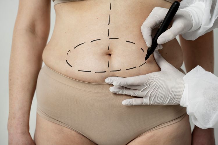 Liposuction Surgery